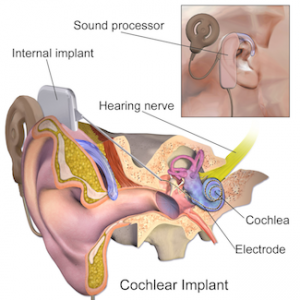 Cochlear Implant Surgery