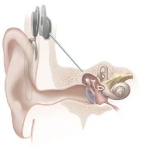 bone conduction hearing aid