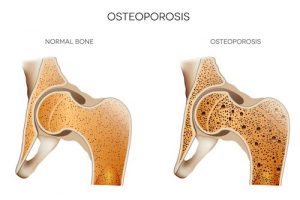  osteoporosis-and-hearing-loss