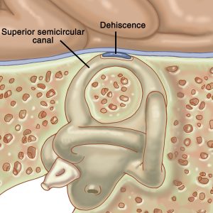 the bone protecting against Superior Semicircular Canal Dehiscence